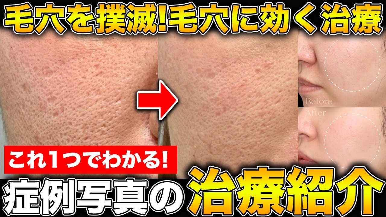 毛穴撲滅！毛穴をなくすオススメの治療の効果を症例ごとに解説