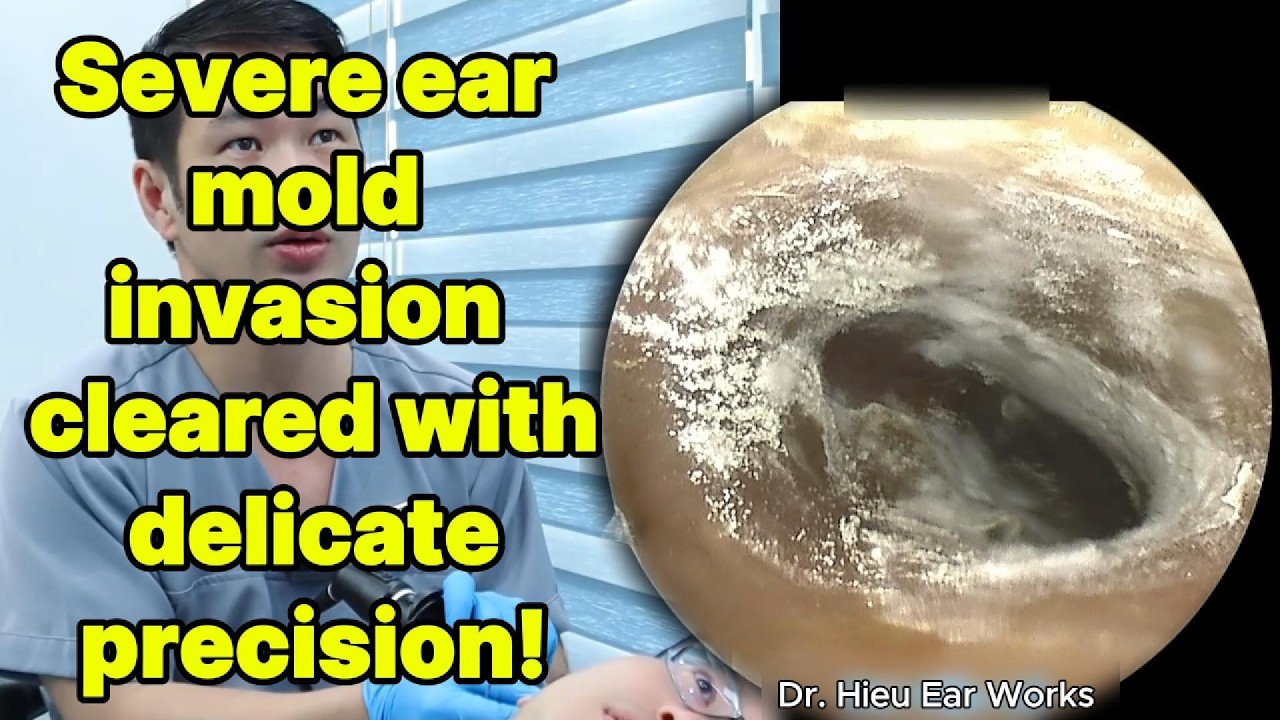Severe ear mold invasion cleared with delicate pre | ear cleaning | ASMR earwax | soothing |relax|