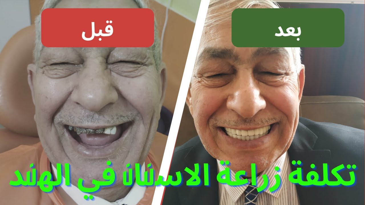 اسعار زراعة الاسنان الفورية و تكلفة زراعة الاسنان في الهند أفضل عيادة الأسنان في الهند