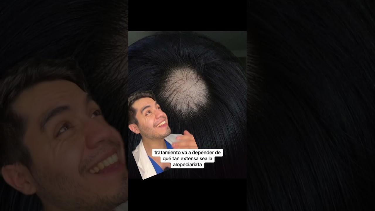 Alopecia areata c&oacute;mo sanar #alopecia #alopeciaareata #pelo