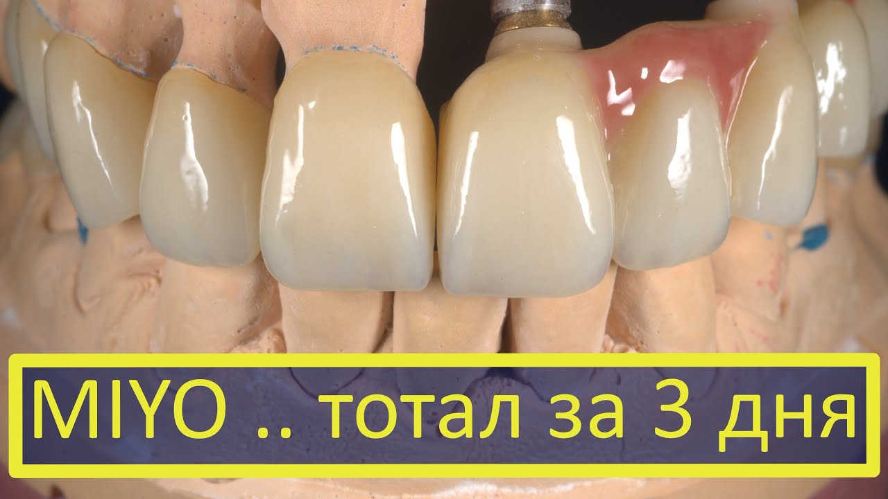 Комбинированная работа на имплантатах и своих зубах, за три дня Цирконий Luxen, жидкая керамика miyo