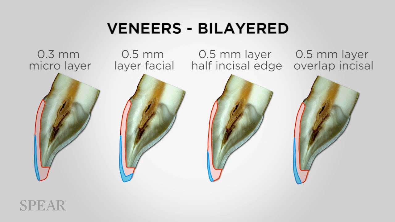 Restorative Materials for Veneers