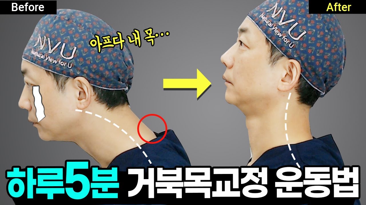 경고) 거북목, 일자목 방치하면 생기는일. 의사가 체험한 거북목 교정법 Turtle Neck | 거북목, 무턱, 이중턱, 비대칭 | 라인만드는 의사 권병소