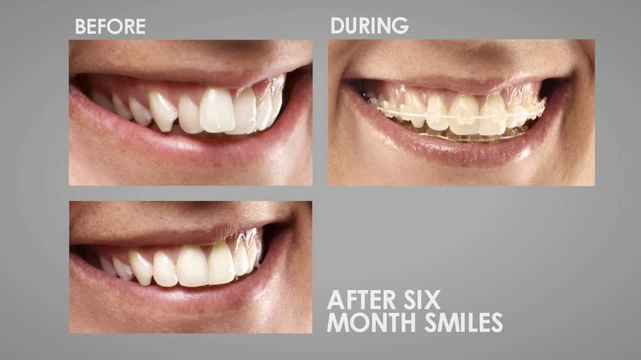 Six Month Smiles in One Minute