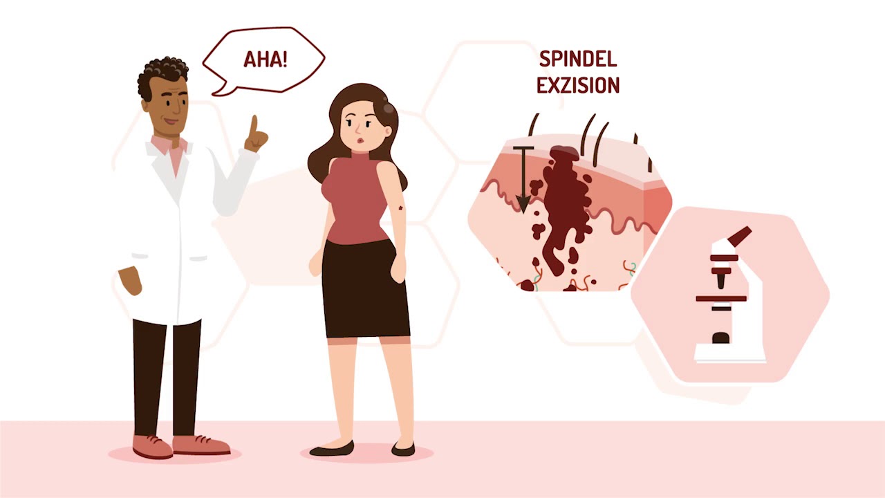 Erklärvideo Melanom 3: Operative Therapien