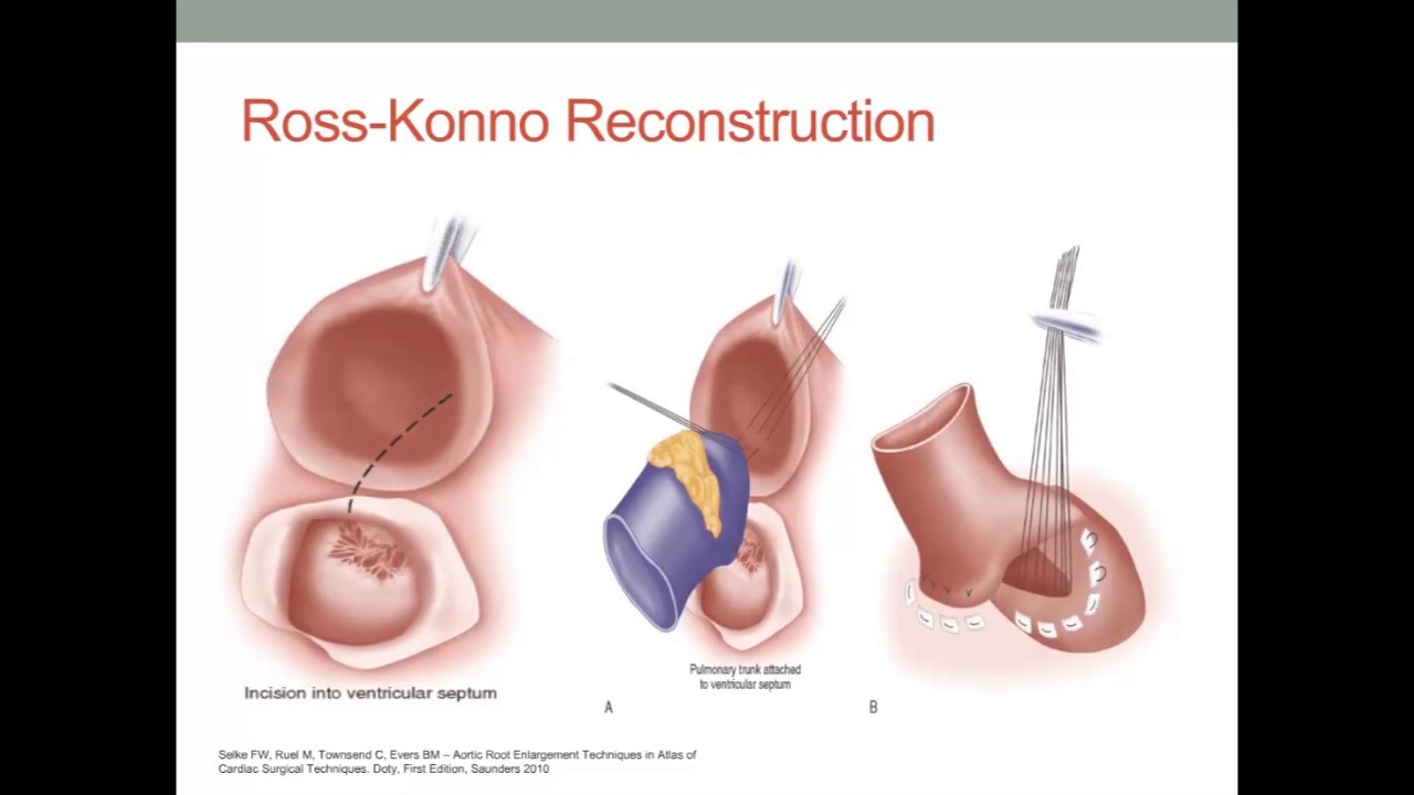 STS University Course 5 Aortic Root Enlarging Procedures and Aortic Valve Leaflet Reconstruction