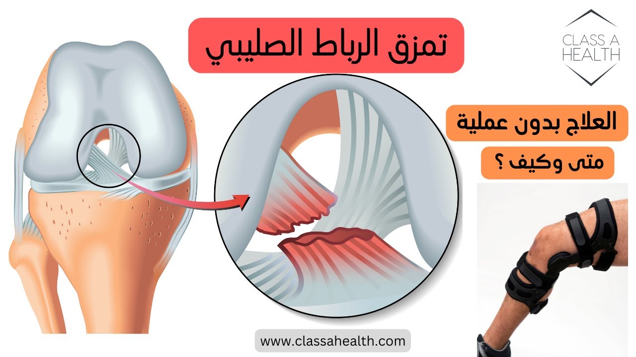 تمزق الرباط الصليبي، متى وكيف يمكن العلاج بدون عملية؟