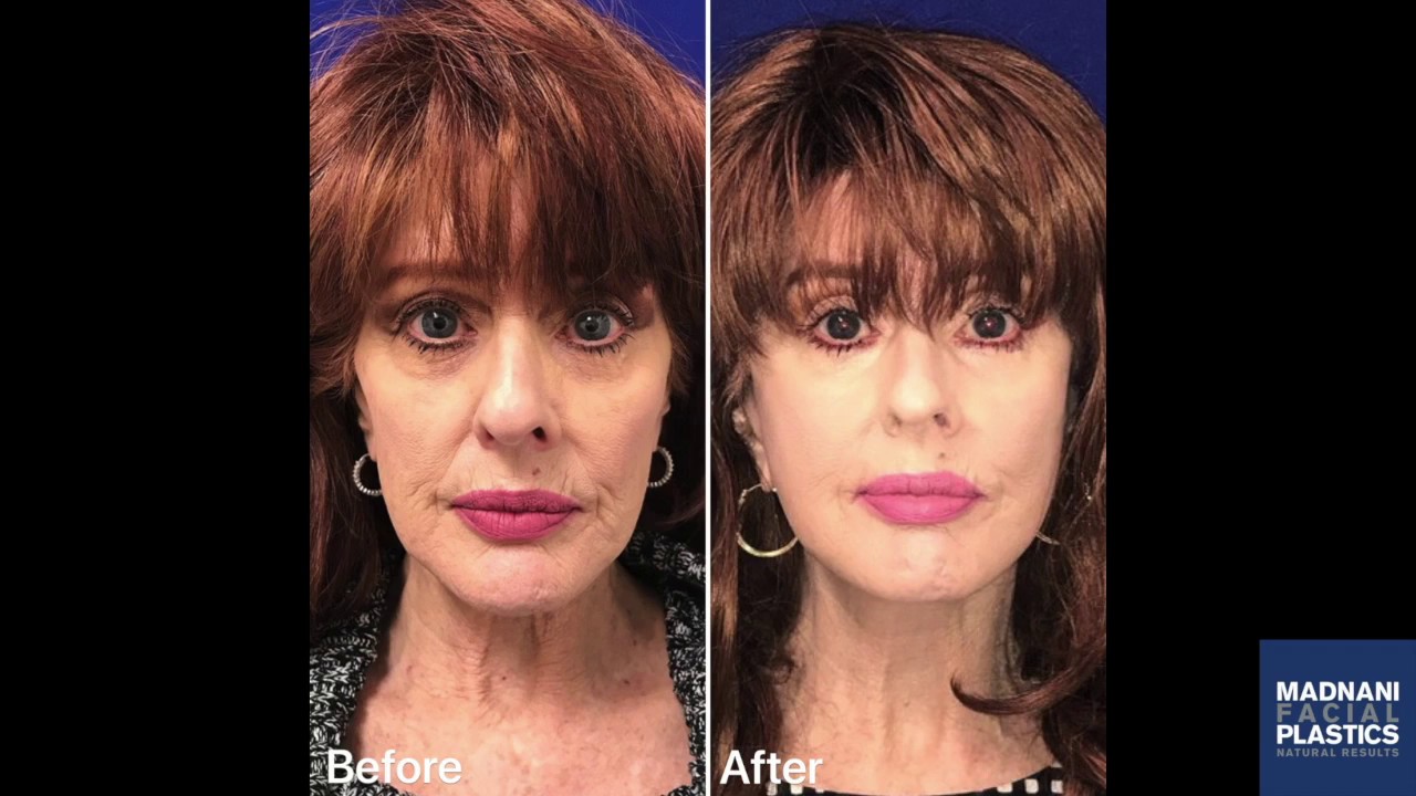 Before and After Photos: MiniLift, Lower Blepharoplasty, CO2 Laser | Patient Testimonial