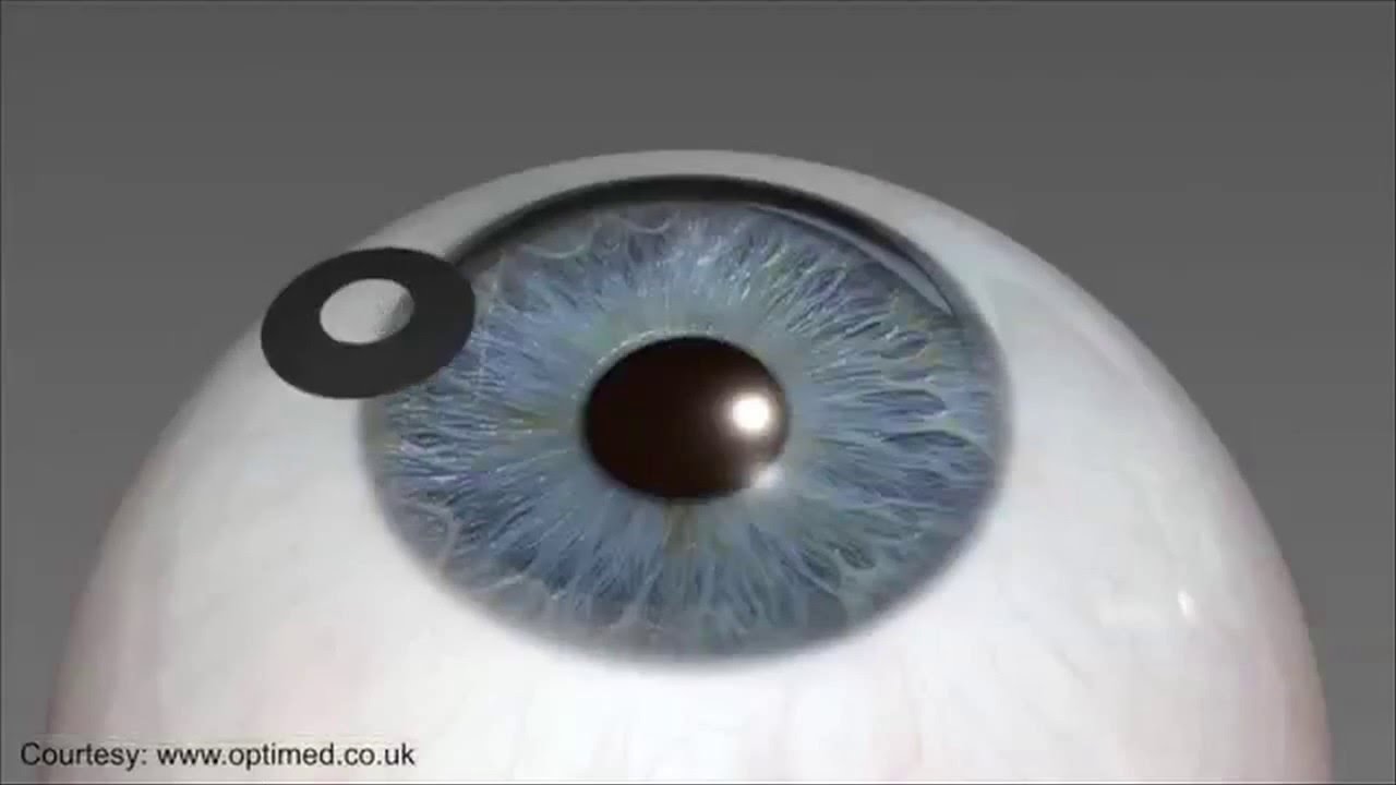 Inside Talkapolis: Kamra Procedure, Save 25%