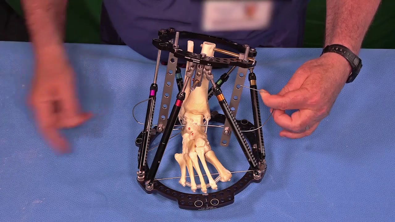 Residual Clubfoot Deformity   Ponseti Sequence  Hexapod Long Bone Frame Fixation Technique and Plann