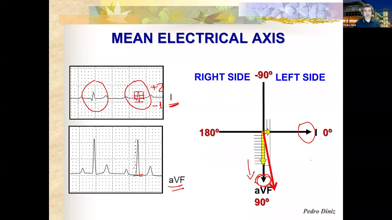 Simple ways to determine the Mean Electrical Axis on ECGs of dogs and cats