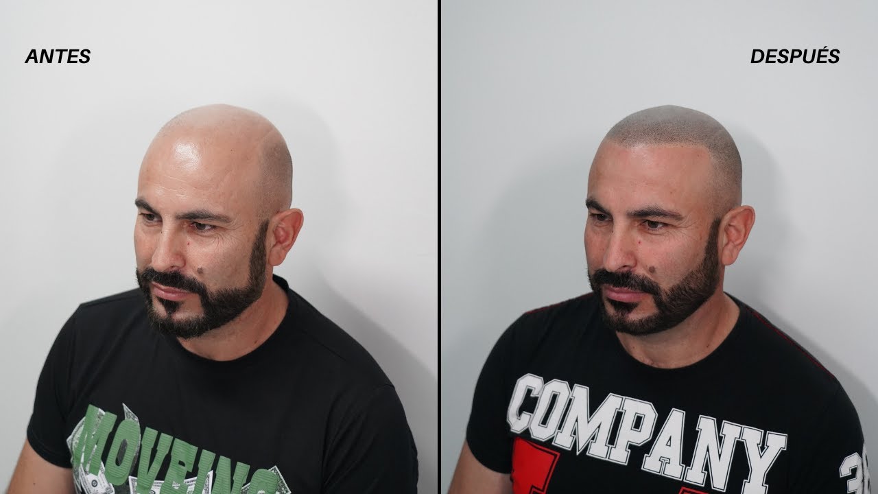 MICROPIGMENTACIÓN CAPILAR · Todo explicado antes y después