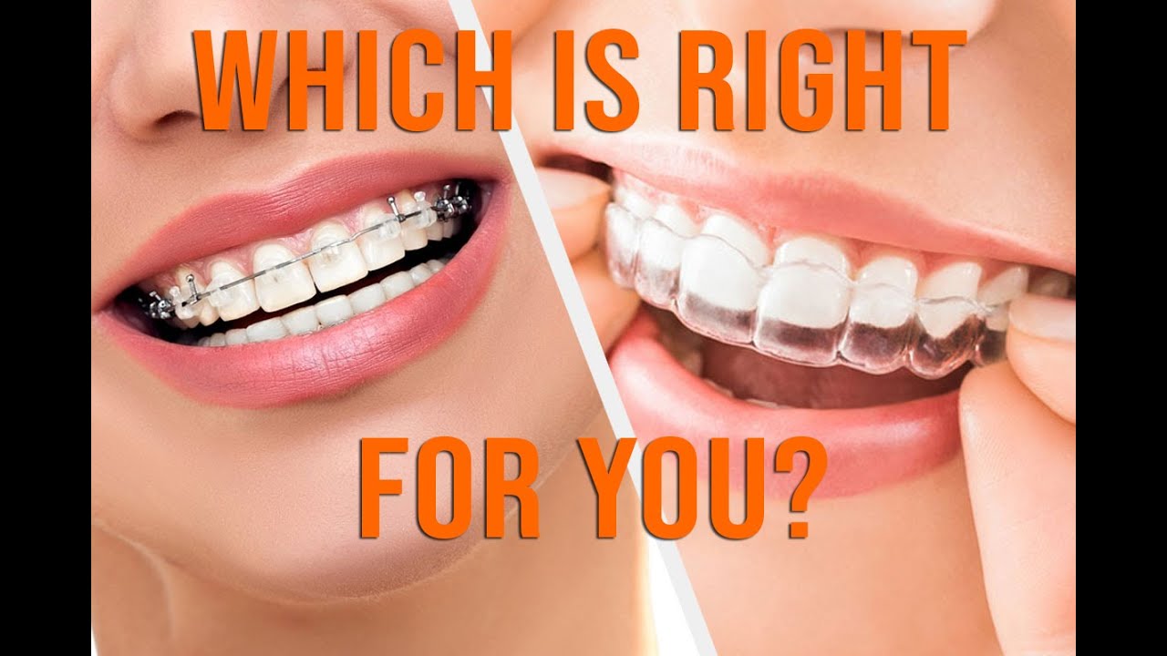 Clear Braces vs White Braces for Adults - Which is right for you?
