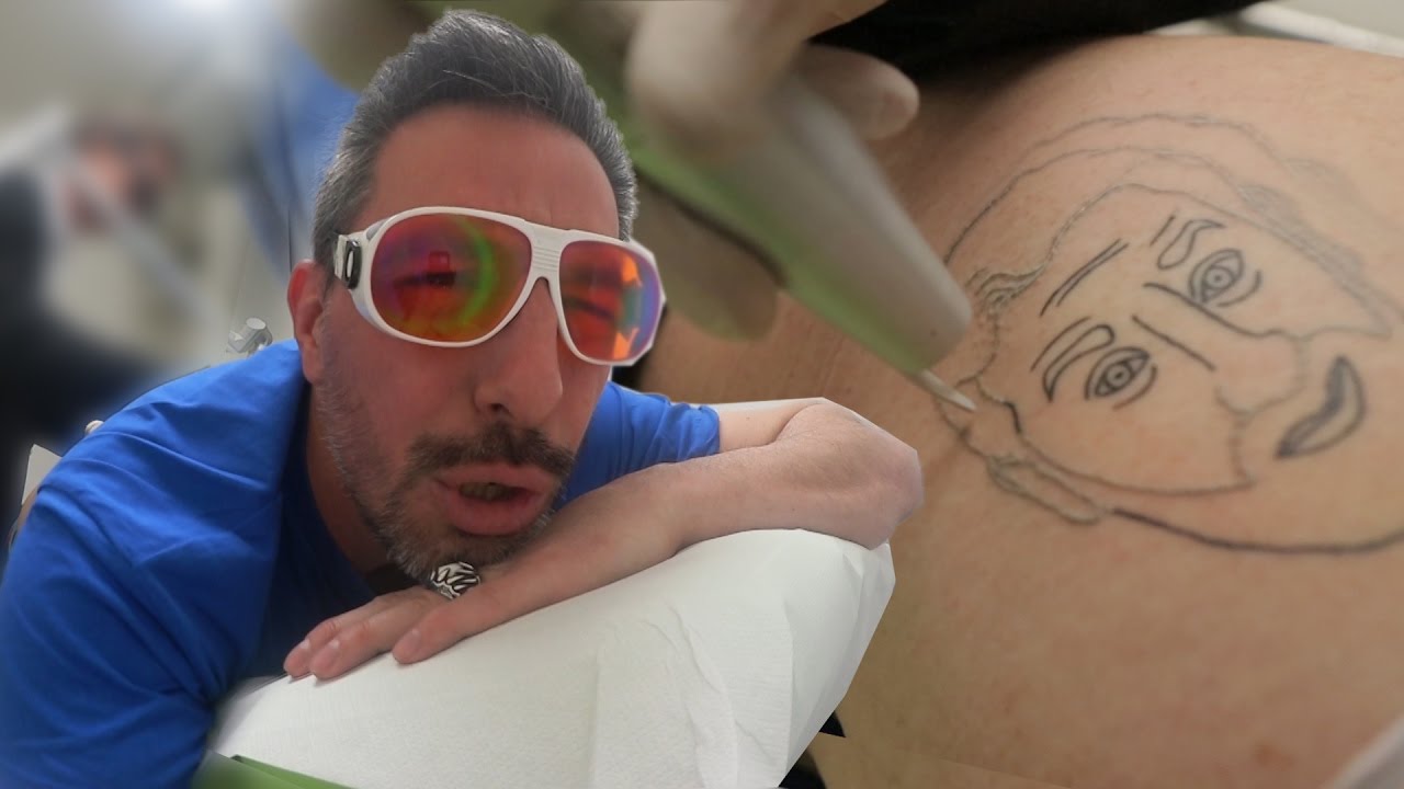 J'AI TESTÉ: LE DÉTATOUAGE AU LASER
