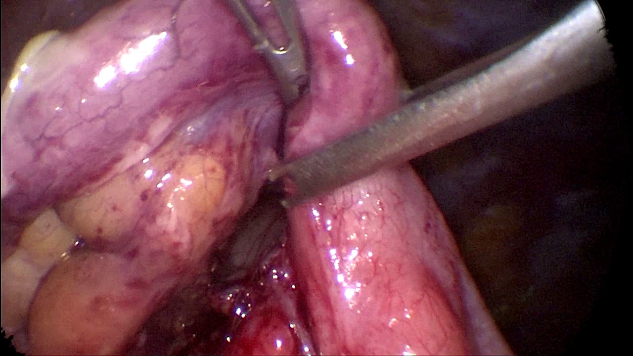 APENDICECTOMIA LAPAROSCOPICA / Hemolock + bipolar simple