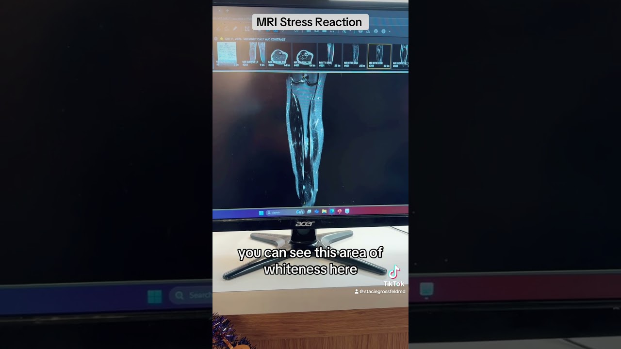Stress Fracture / Stress Reaction Tibia MRI