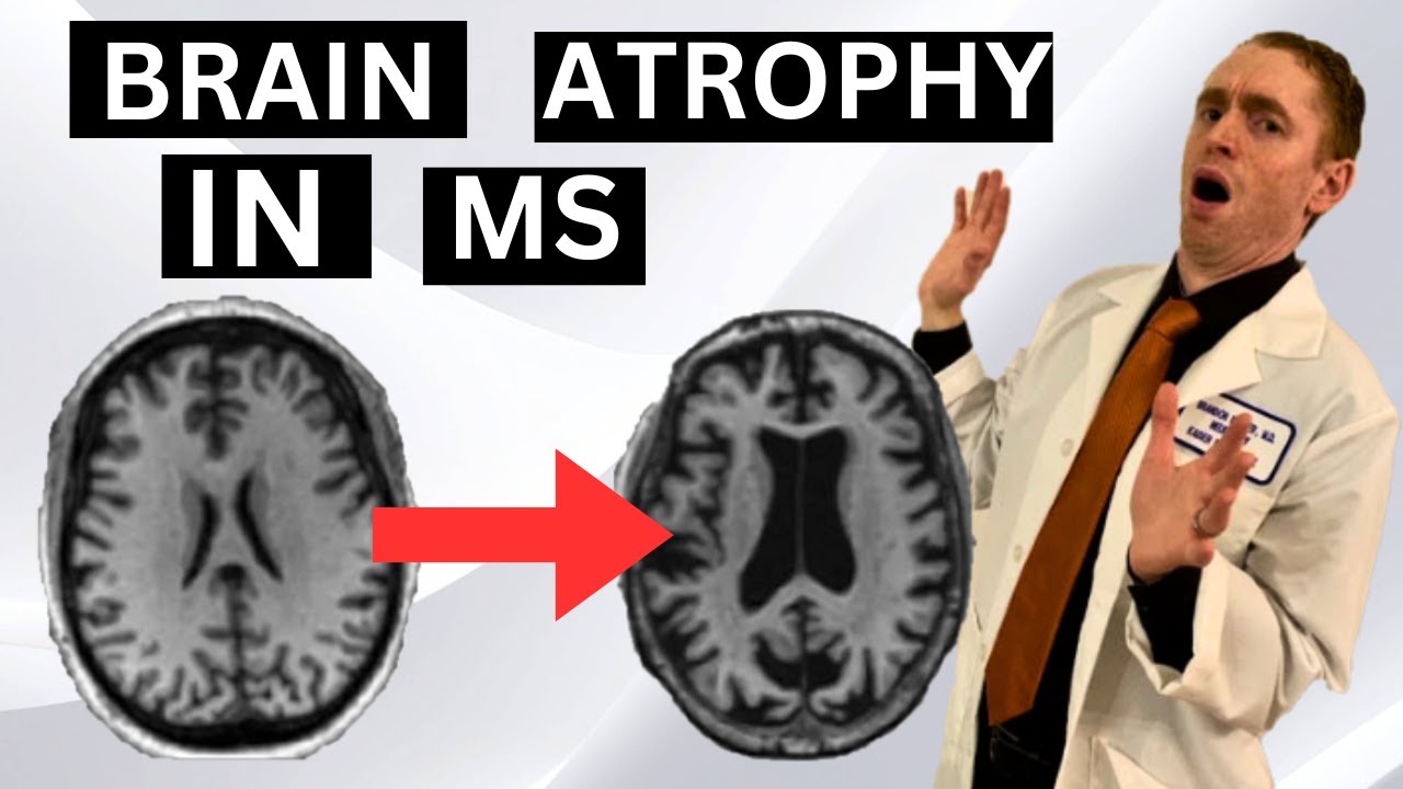 Brain Atrophy in Multiple Sclerosis Explained by Neurologist