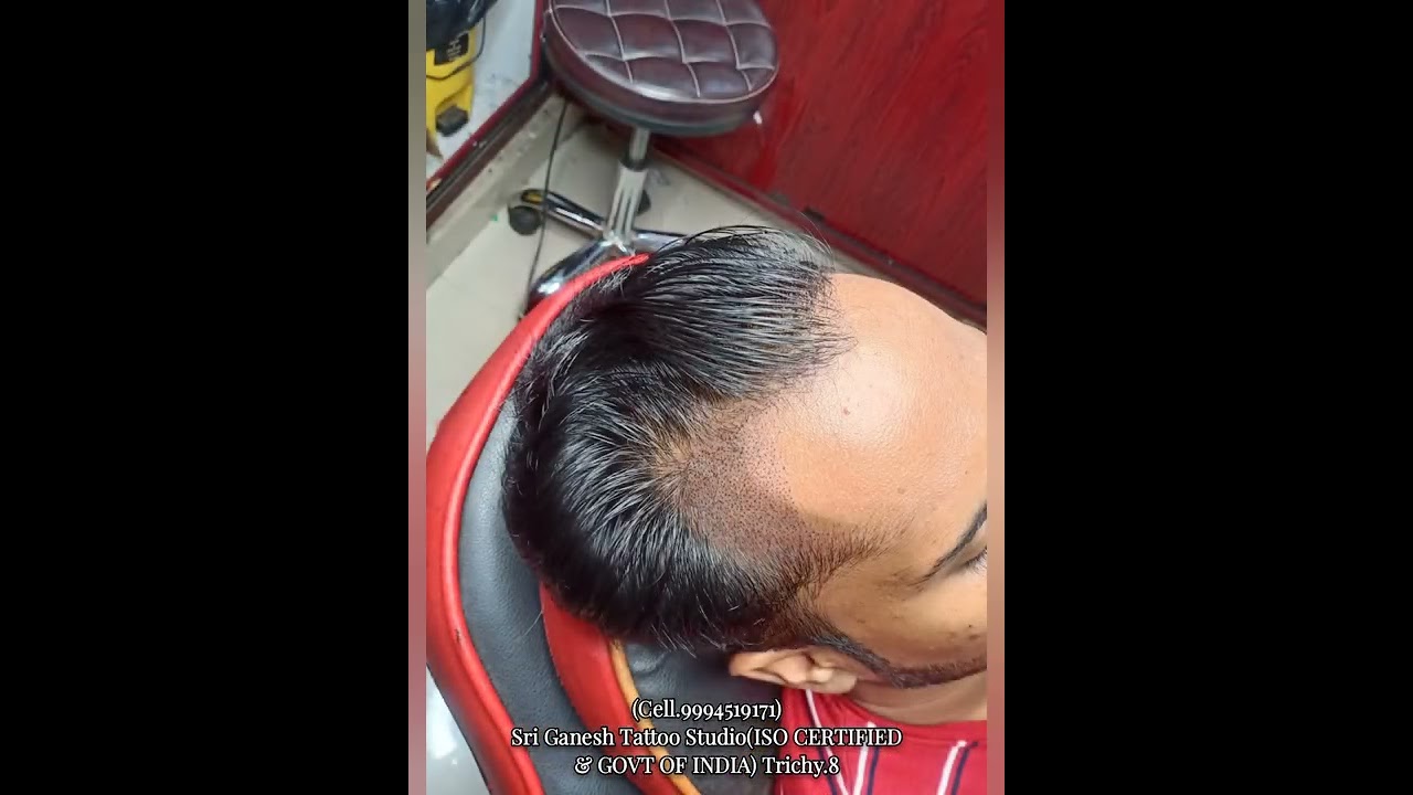 Forehead Permanent Hair pigmentation