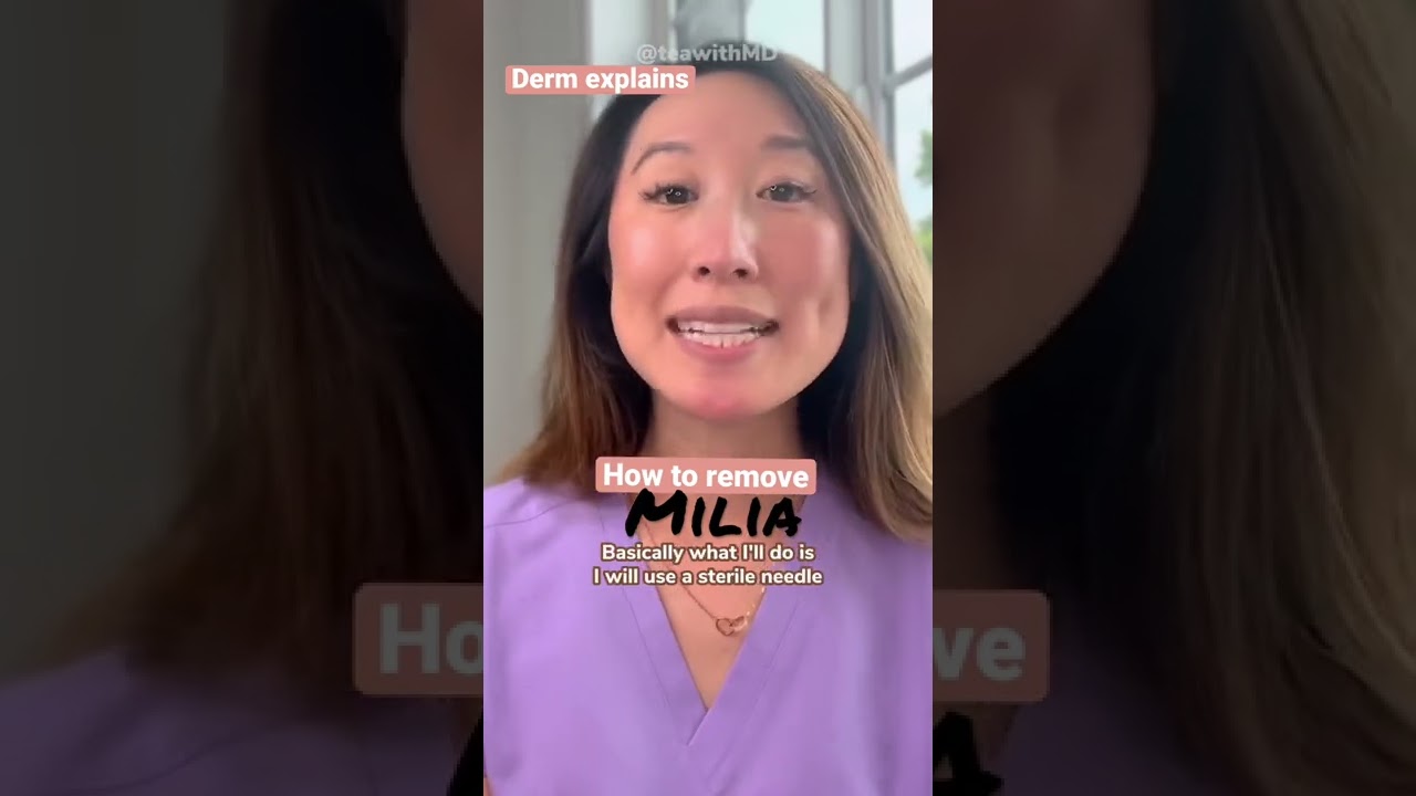 Removing #milia #acne surgery by a #dermatologist | #shorts
