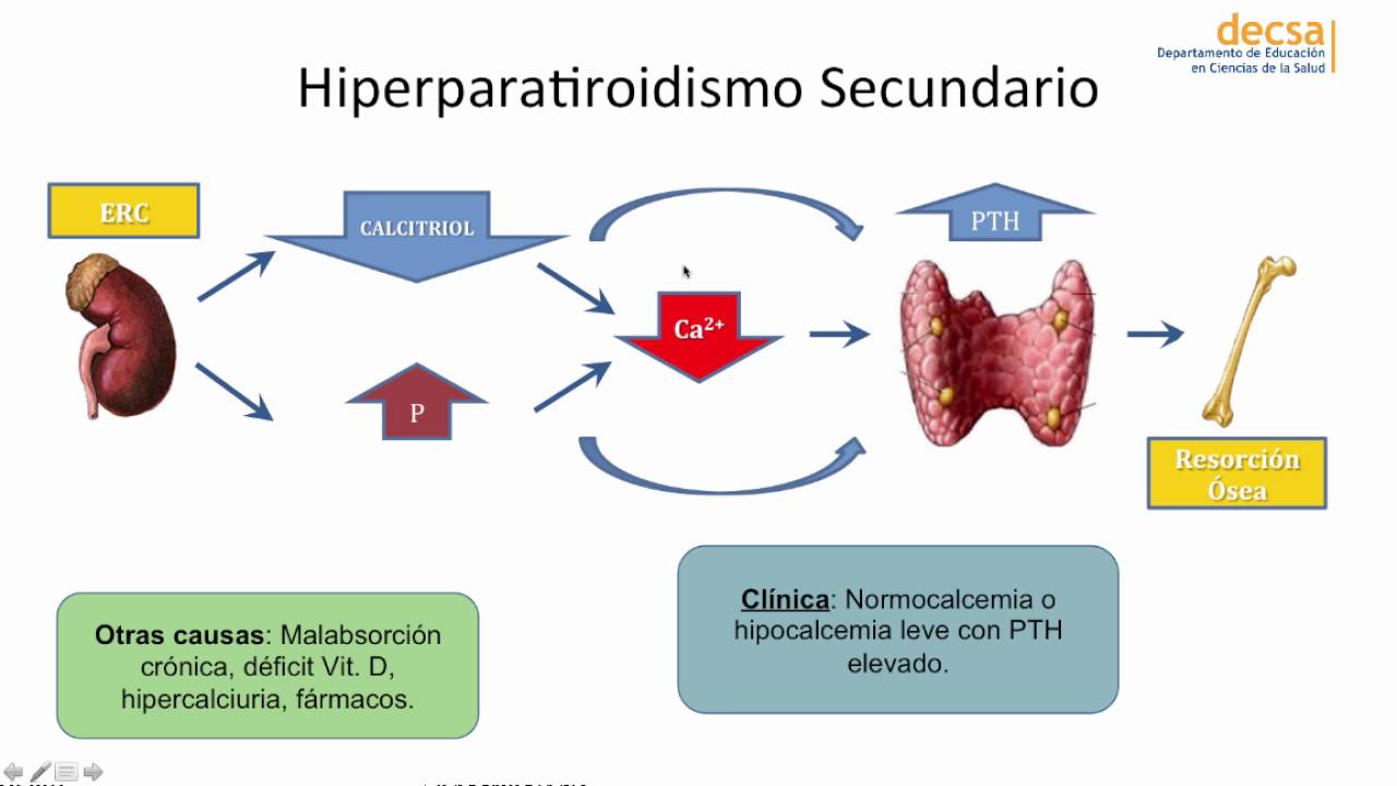 Hiperparatiroidismo