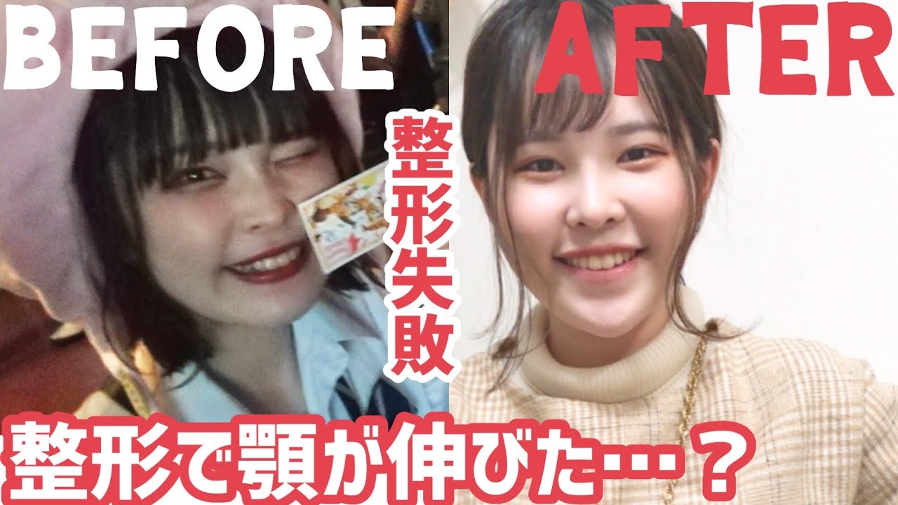 面長が整形する時の落とし穴【写真付き】