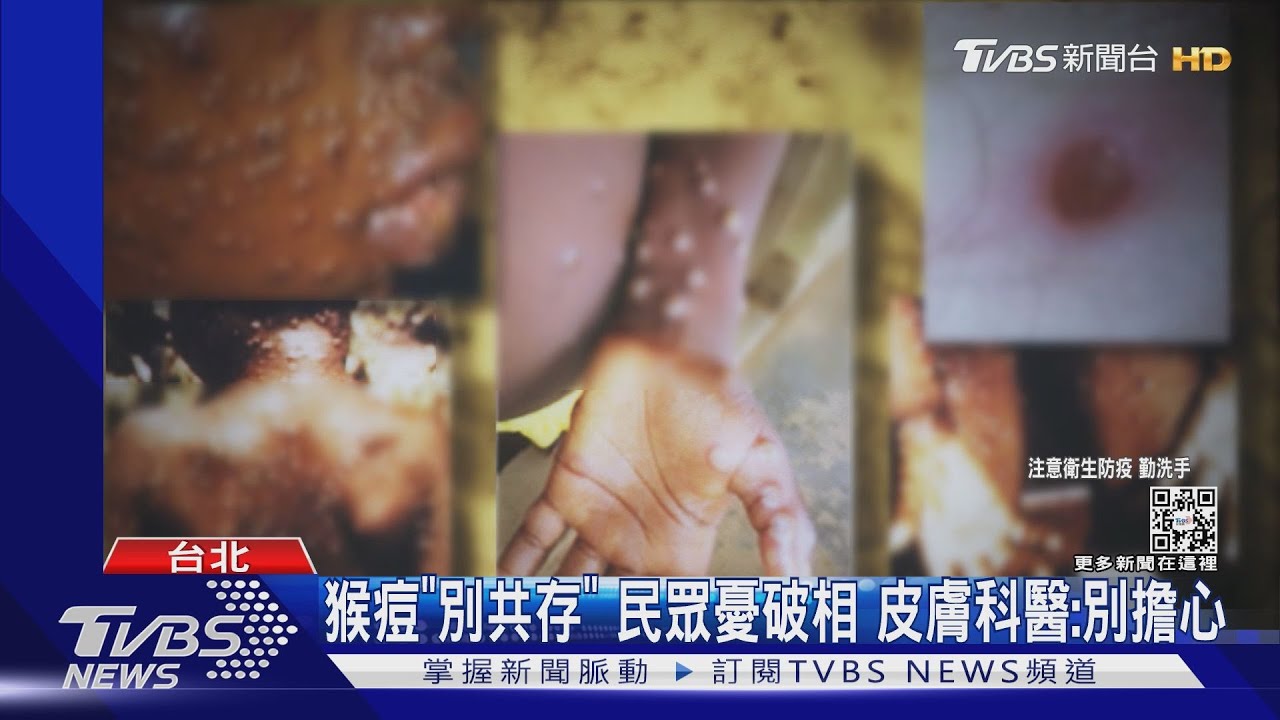 猴痘「別共存」 民眾憂破相 皮膚科醫:別擔心｜TVBS新聞