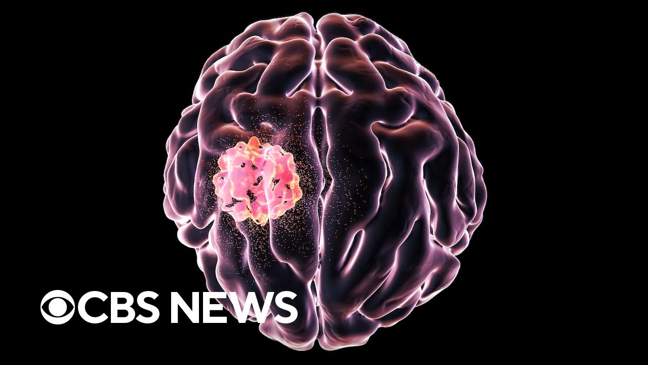 What is the aggressive brain cancer glioblastoma?