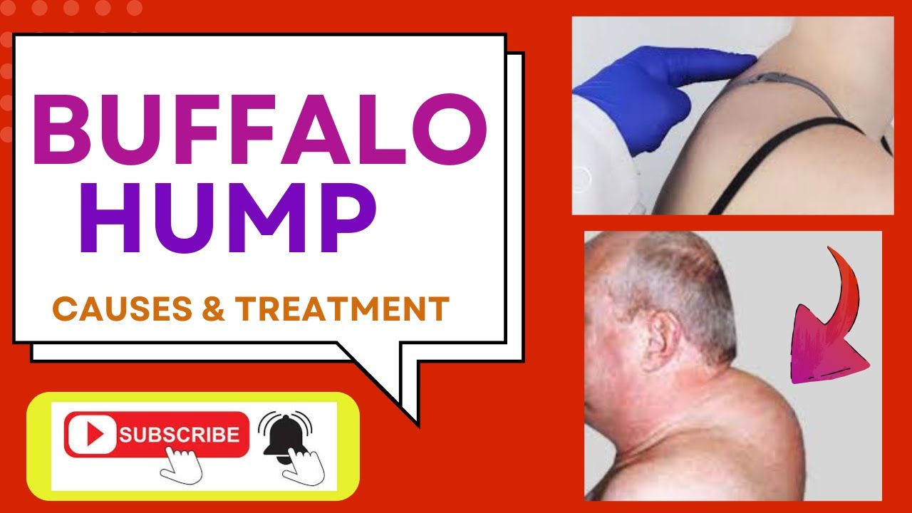 Buffalo Hump-Treatment of Buffalo Hump|गर्दन के पीछे सूजन का इलाज |Causes & Mechanism|healtheducatum