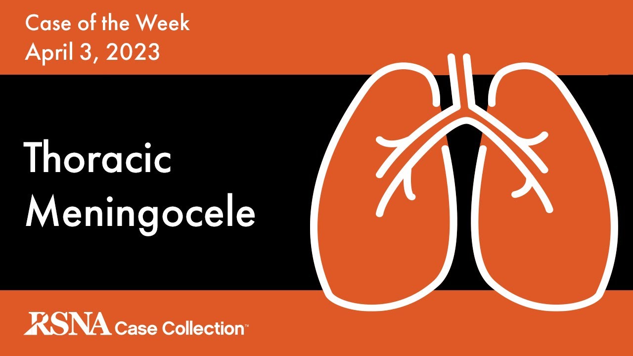 Case of the Week: Thoracic Meningocele