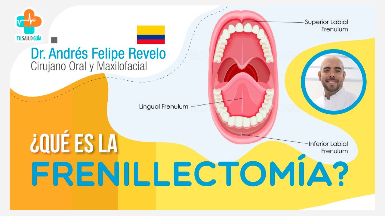 &iquest;Qu&eacute; es la Frenillectom&iacute;a? | Tu Salud Gu&iacute;a
