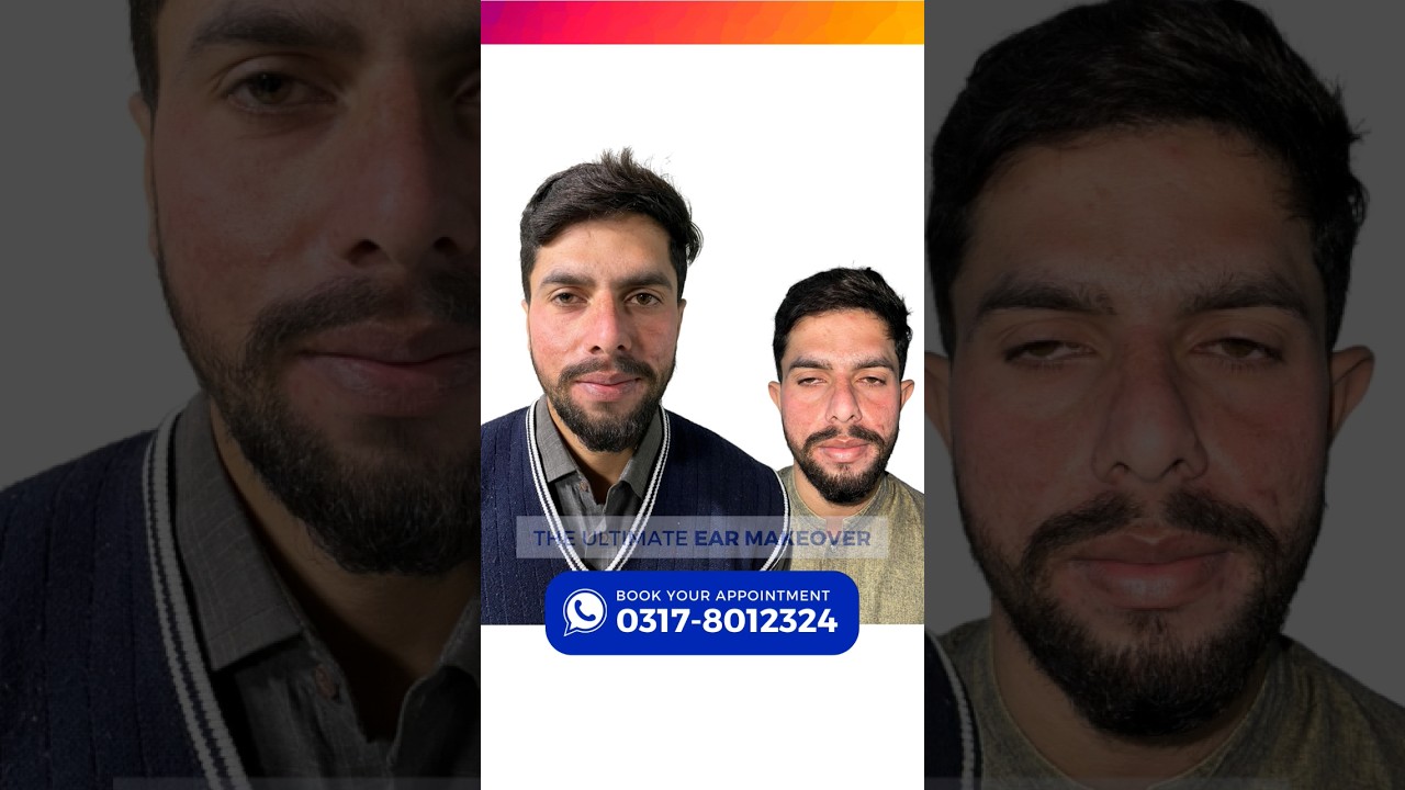 Ear Reshaping | Otoplasty by Dr. Kamal | Cosmetico Clinic