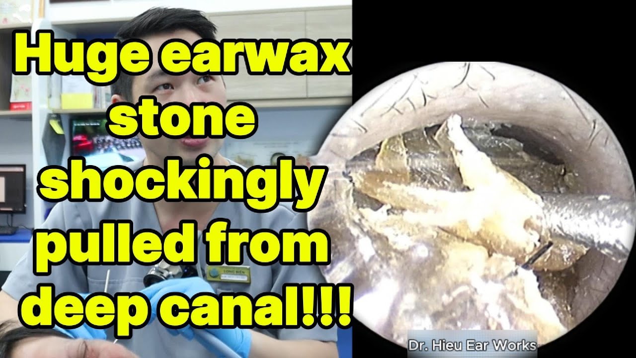 Huge earwax stone shockingly pulled from deep cana | ear cleaning | ASMR earwax | soothing |relax|