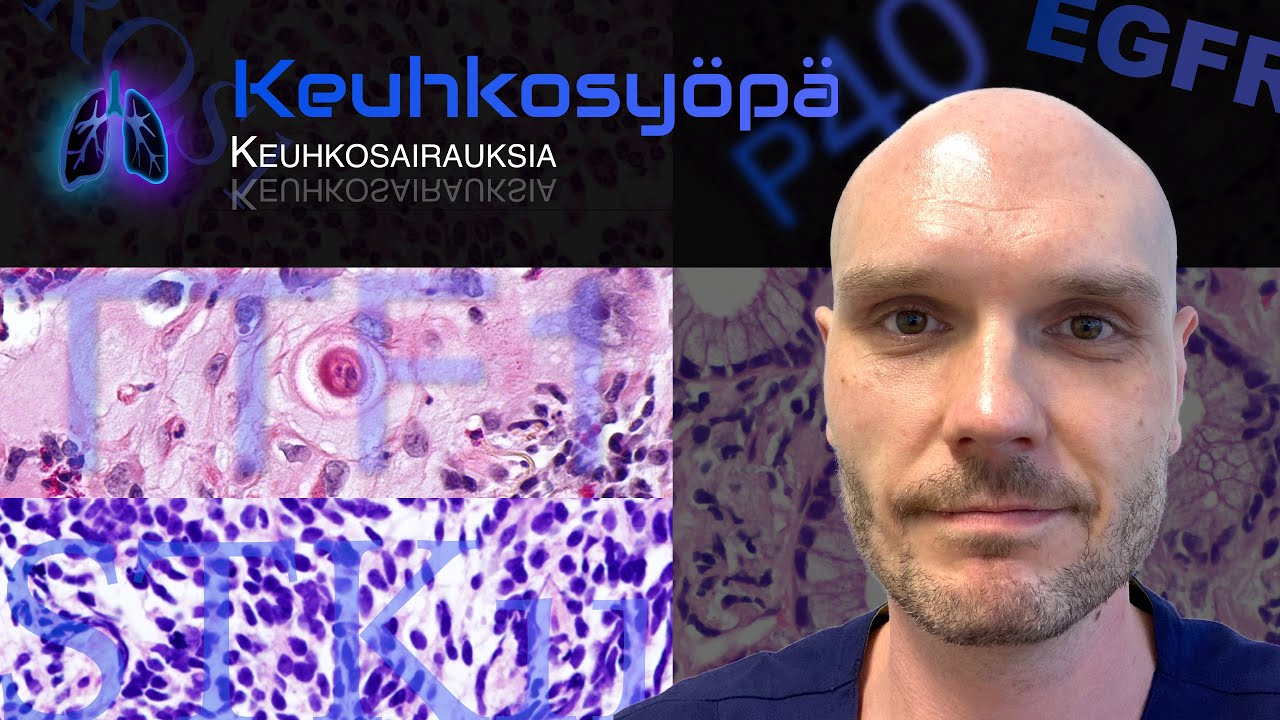 Keuhkosyöpä