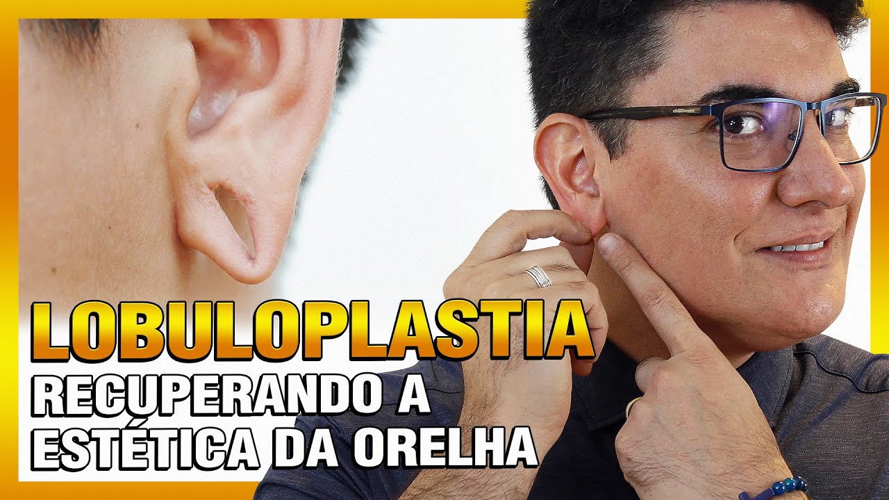Lobuloplastia | Recuperando a Estética da Orelha