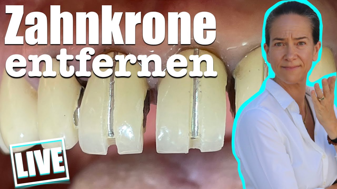 ZAHNKRONEN entfernen? Ablauf