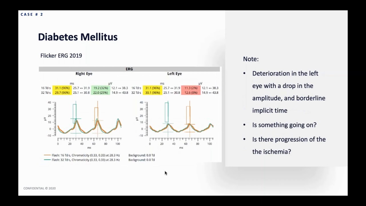 Dr.  Weber Using ERG with the RETeval to Track NPDR Progressing to PDR