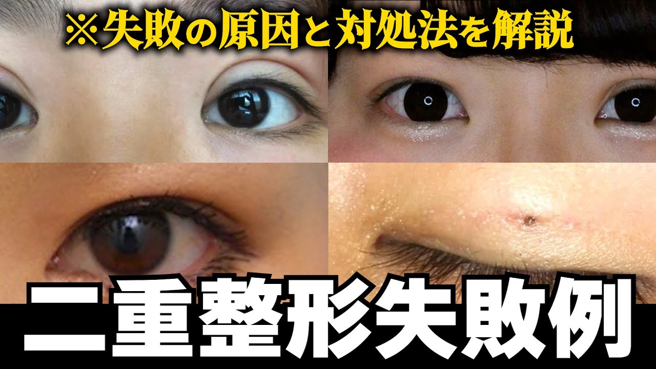 【二重整形失敗】「ハム目」「左右差」なぜ失敗が起きるのか？原因と対処法を詳しく解説します！！