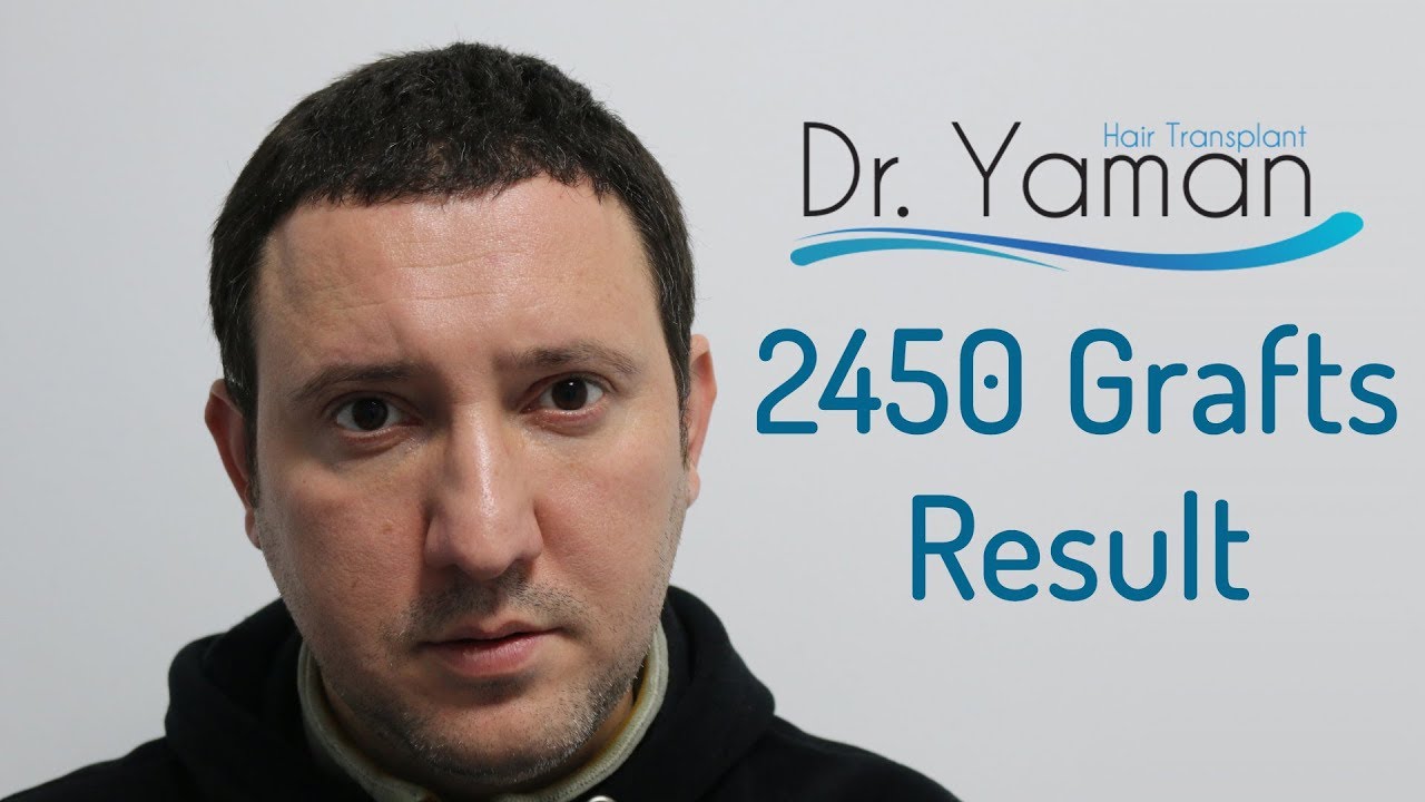 Dr Resul Yaman Hair Clinic - 2450 Grafts Result
