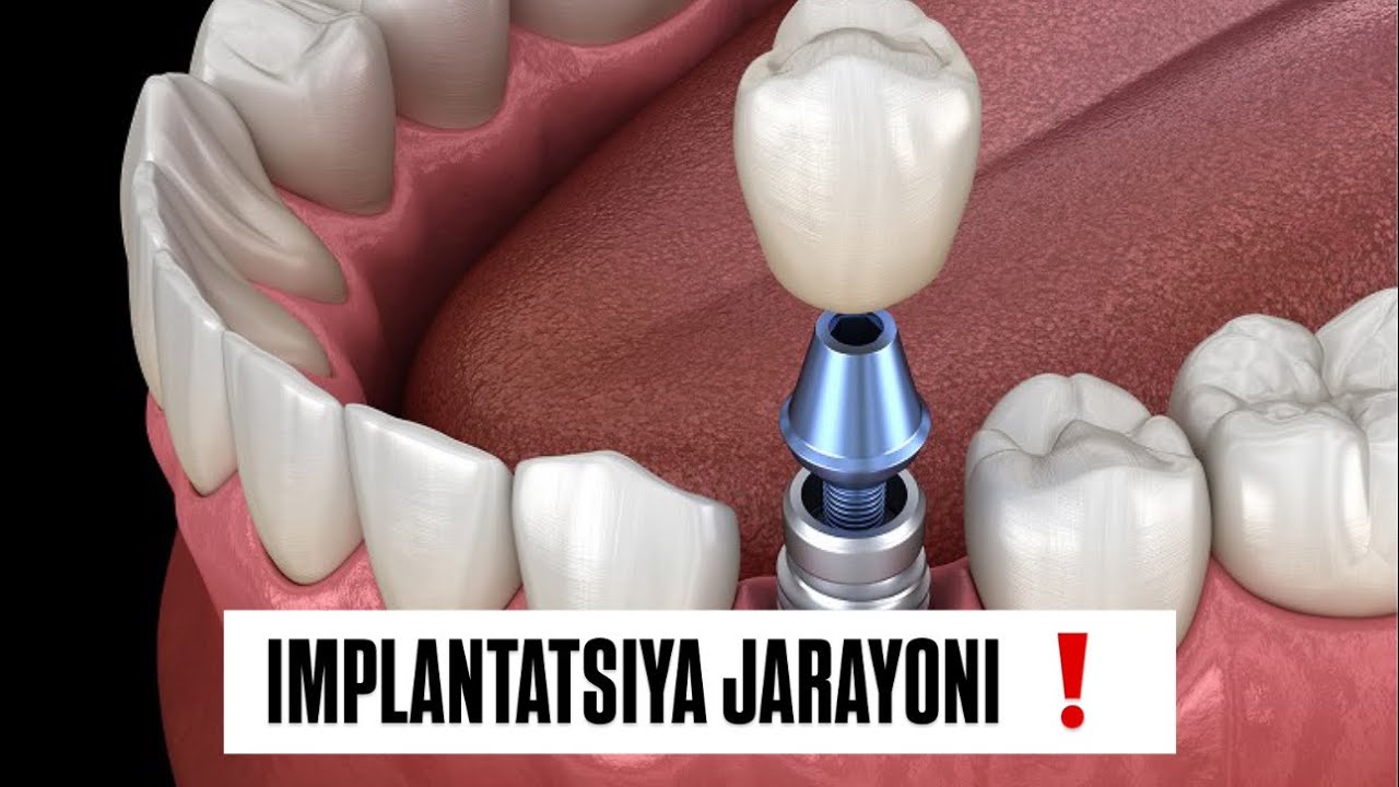Implantatsiya jarayoni ❗️ #dentist#shifokor#smile#tibbiyot#doctor#rek#film#dentistry#doctor#top 