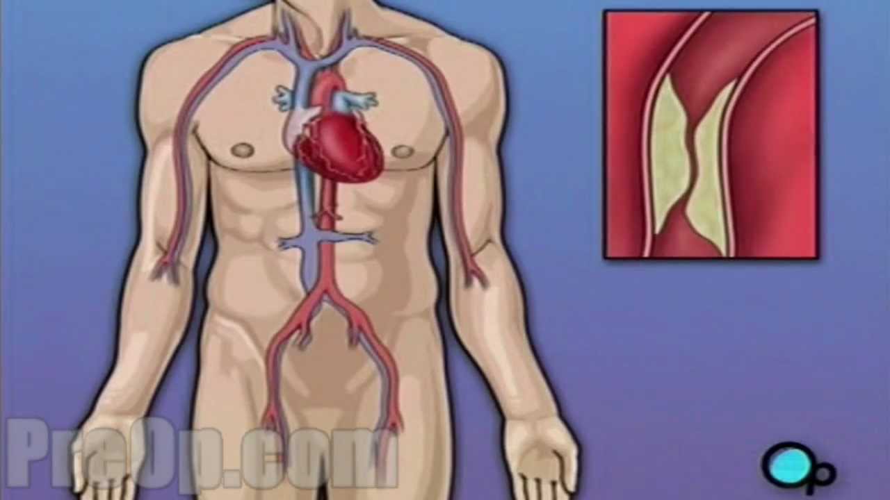 Coronary Artery Bypass Graft (CABG) Surgery - PreOp Patient Education