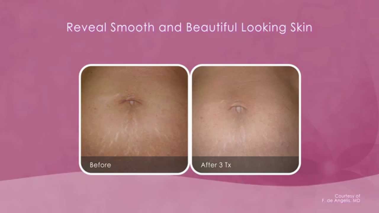 Laser Stretch Mark Removal London