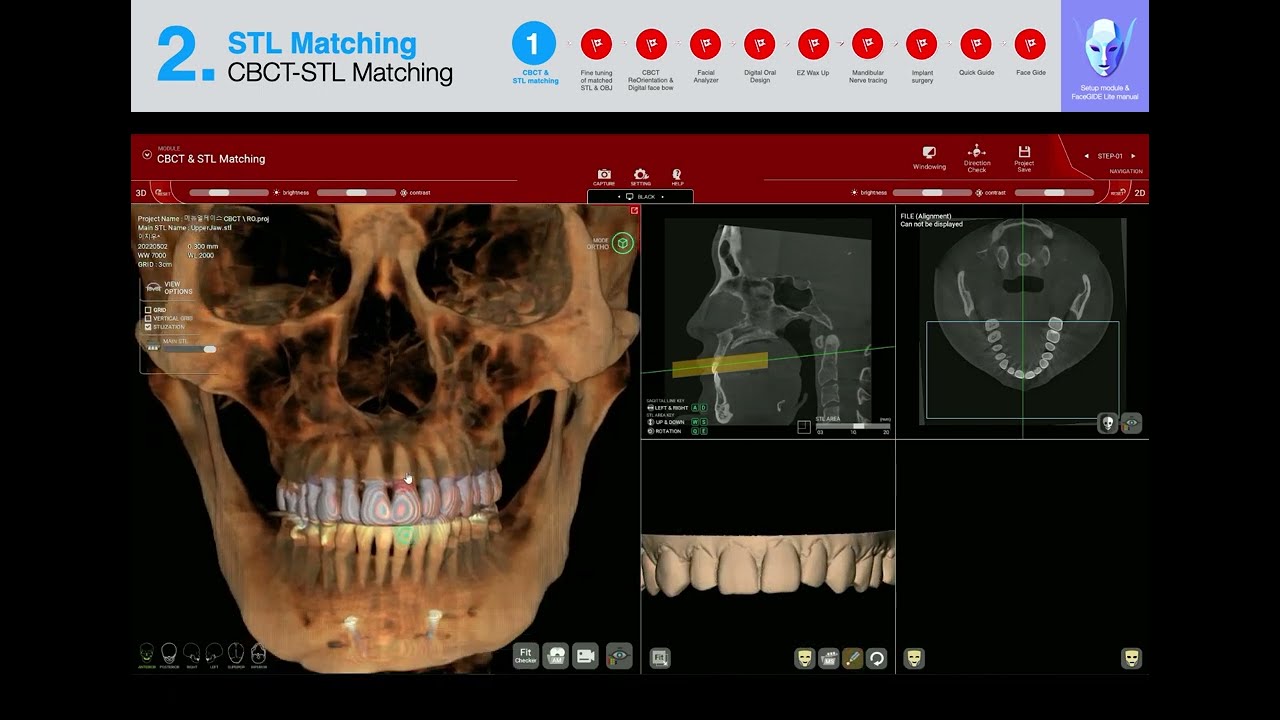 FaceGIDE Setup Mode Tutorial #01 CBCT & STL matching