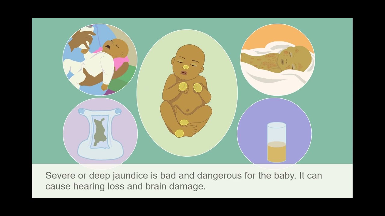Jaundice in the newborn