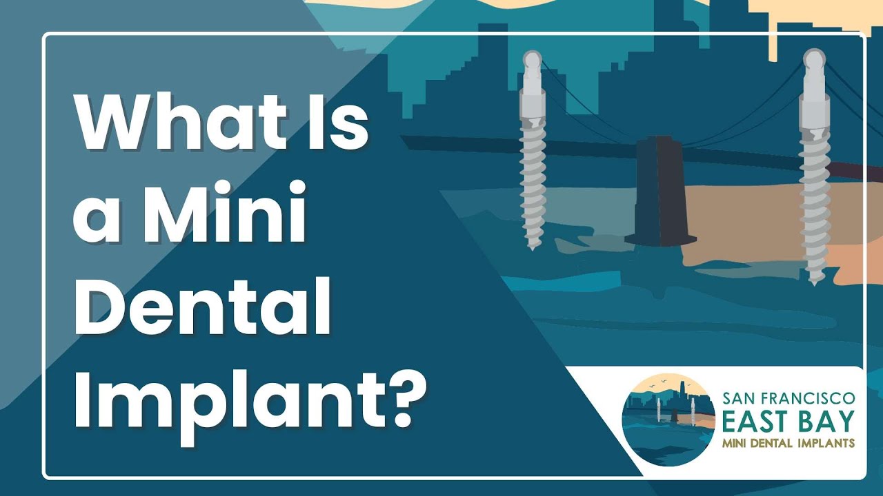 What Is a Mini Dental Implant? | SF East Bay Mini Dental Implants | Dr. Rose Magno #DentalImplants
