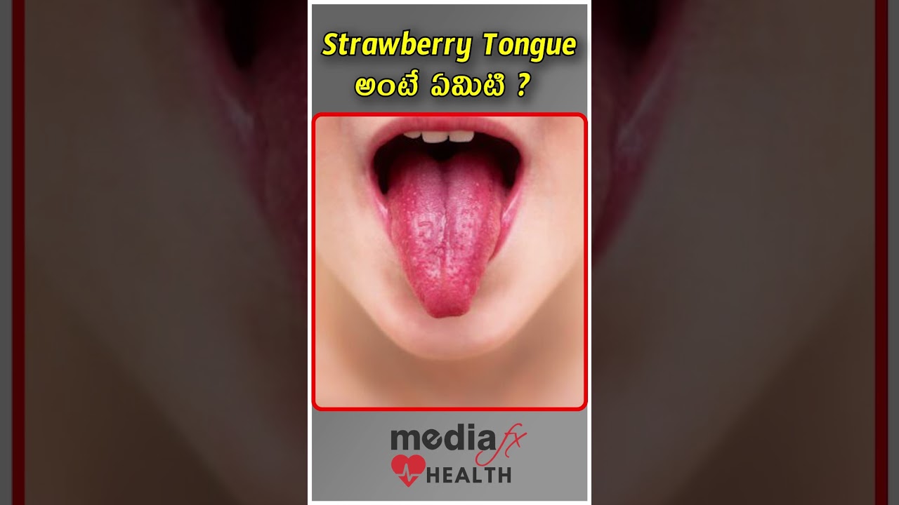 strawberry tongue  అంటే ఏమిటి ? | MediaFxHealth