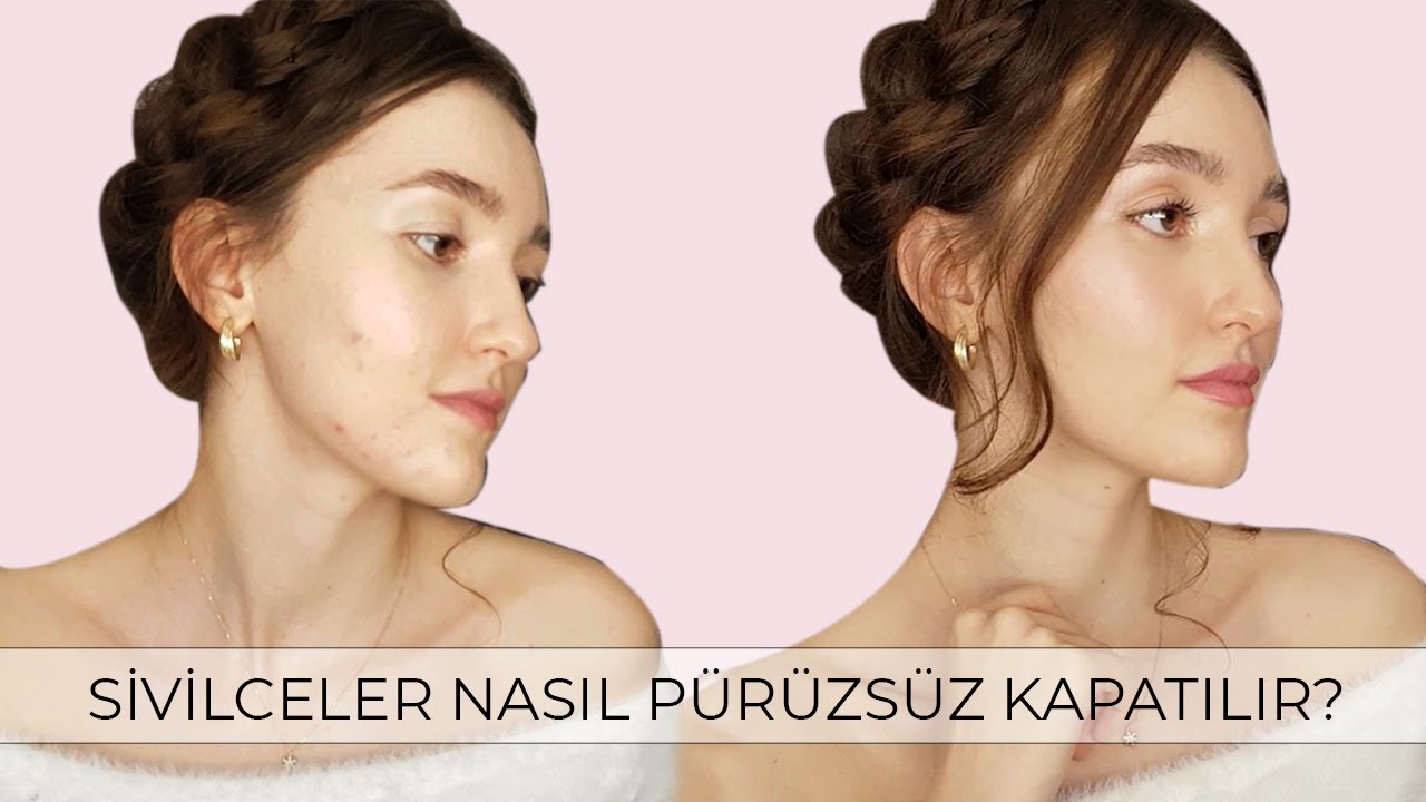 Sivilceler Nasıl Kapatılır? | &Ouml;zel T&uuml;yolar