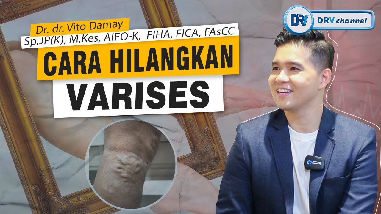 Dr Vito | Penyebab Varises dan Cara Mengatasinya