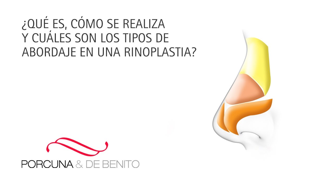 ¿Qué es, cómo se realiza y cuáles son los tipos de abordaje de una rinoplastia?