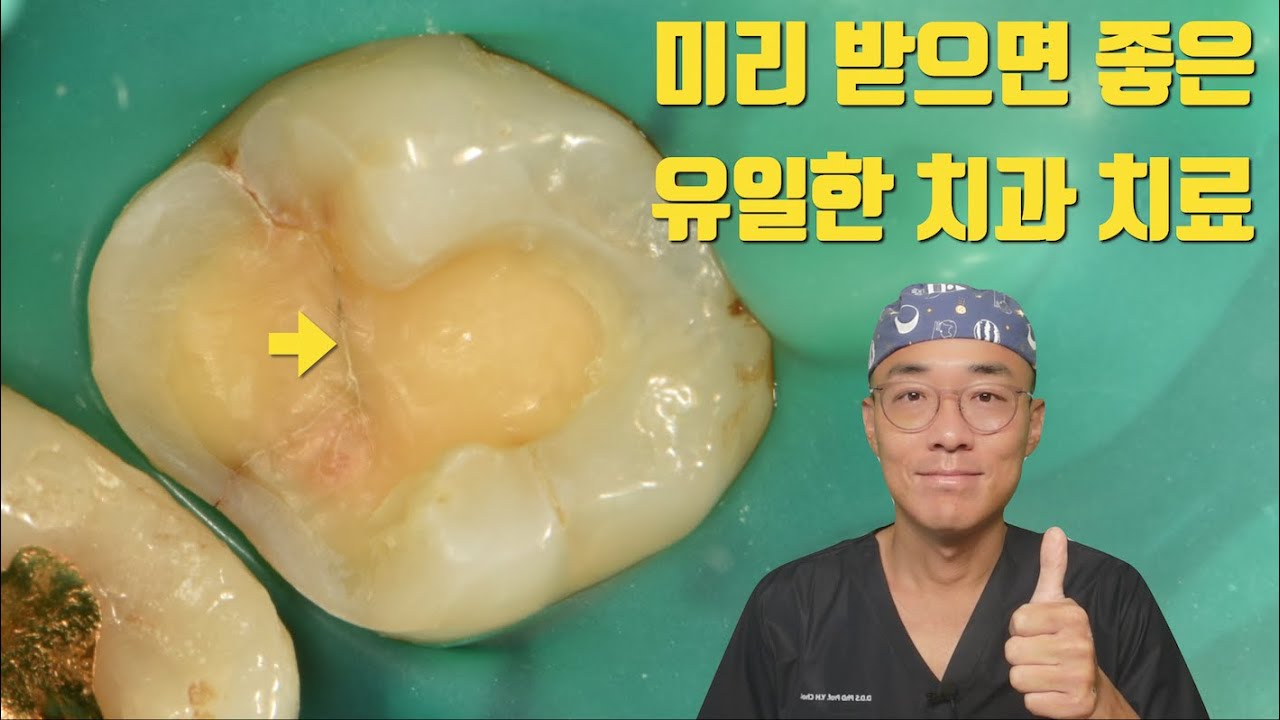 초기 크렉은 미리 치료하는 걸 추천합니다 #치아살리기 #판교최용훈치과 #플라젠신경치료