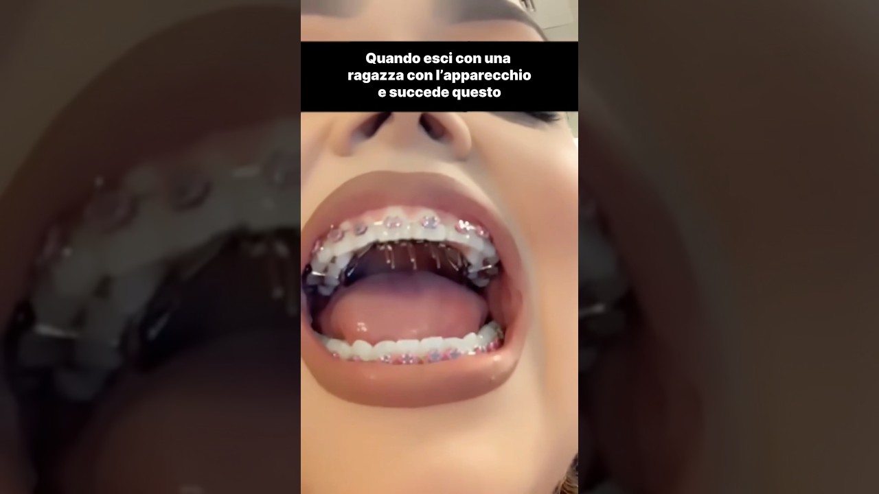 Quando esci con una ragazza con l'apparecchio e succede questo 💀 @OuzPlus
